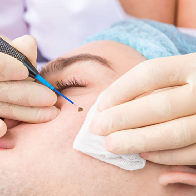 Skin Tag, Wart, Mole Removal